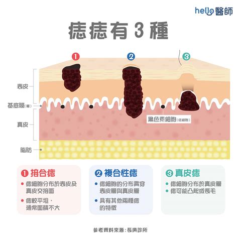 陰囊 痣|陰囊長痣？5大原因揭秘